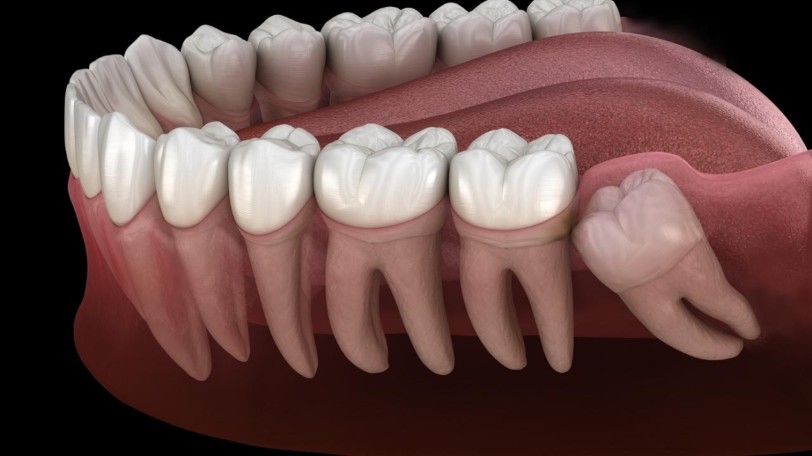 Wisdom Teeth Removal in Manchester