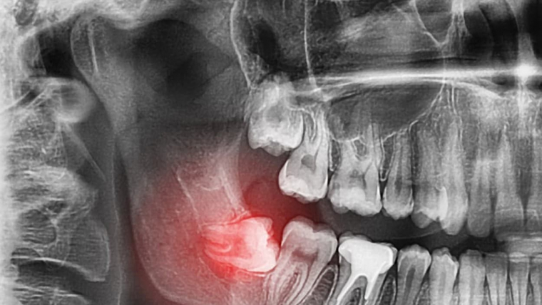 Everything You Need to Know About Wisdom Tooth Extraction